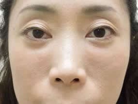 目の下のクマ・タルミ症例手術１ヵ月後（メイクあり）