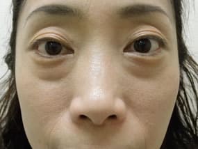 目の下のクマ・タルミ症例手術前