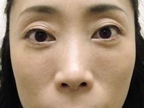 目の下のクマ・タルミ症例手術３ヶ月後