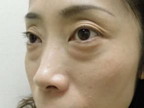 目の下のクマ・タルミ症例手術前