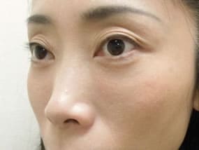 目の下のクマ・タルミ症例手術３ヶ月後