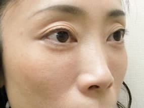 目の下のクマ・タルミ症例手術３ヶ月後