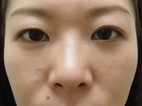 目の下のクマ・タルミ症例手術２ヶ月後