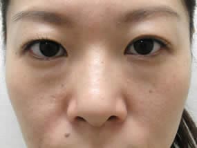 目の下のクマ・タルミ症例手術前（メイクあり）