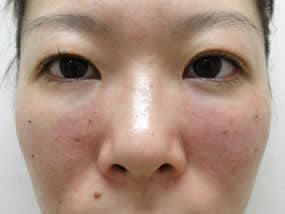 目の下のクマ・タルミ症例手術直後（メイクなし）