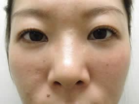 目の下のクマ・タルミ症例手術２週間後（メイクあり）