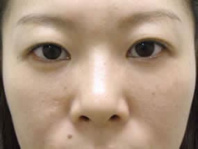 目の下のクマ・タルミ症例手術１ヵ月後（メイクあり）