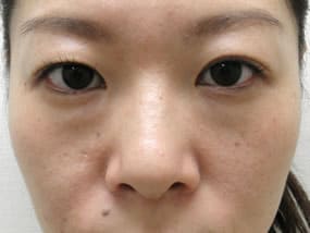 目の下のクマ・タルミ症例手術前