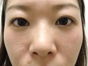 目の下のクマ・タルミ症例手術３ヶ月後