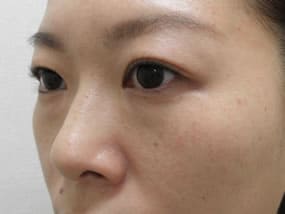 目の下のクマ・タルミ症例手術前