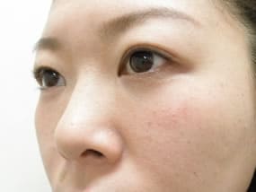 目の下のクマ・タルミ症例手術３ヶ月後