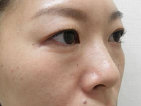 目の下のクマ・タルミ症例手術前