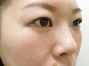 目の下のクマ・タルミ症例手術３ヶ月後