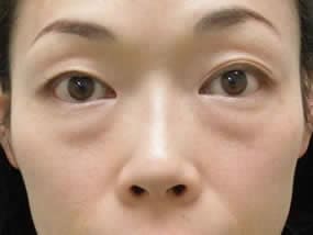 目の下のクマ・タルミ症例手術前（メイクあり）