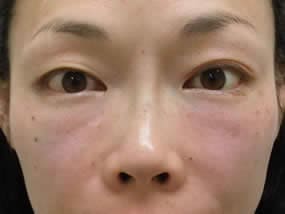 目の下のクマ・タルミ症例手術直後（メイクなし）