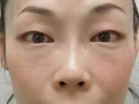 目の下のクマ・タルミ症例手術２週間後（メイクあり）