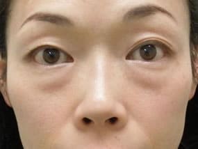 目の下のクマ・タルミ症例手術前