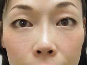 目の下のクマ・タルミ症例手術３ヶ月後