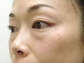 目の下のクマ・タルミ症例手術前
