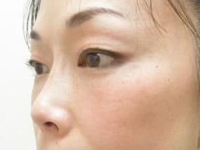 目の下のクマ・タルミ症例手術３ヶ月後