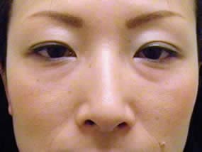 目の下のクマ・タルミ症例手術前（メイクあり）