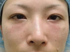 目の下のクマ・タルミ症例手術直後（メイクなし）