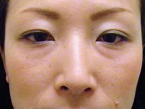 目の下のクマ・タルミ症例手術前