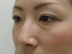 目の下のクマ・タルミ症例手術前