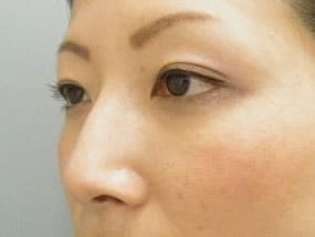 目の下のクマ・タルミ症例手術３ヶ月後