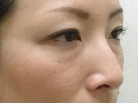 目の下のクマ・タルミ症例手術前