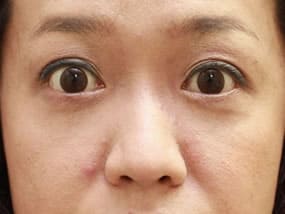 目の下のクマ・タルミ症例手術３ヶ月後