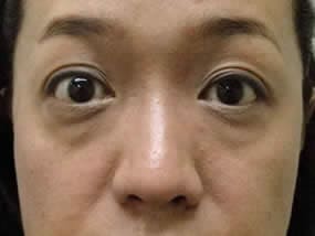 目の下のクマ・タルミ症例手術前（メイクあり）