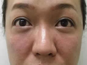目の下のクマ・タルミ症例手術直後（メイクなし）