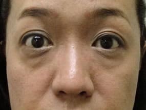 目の下のクマ・タルミ症例手術前