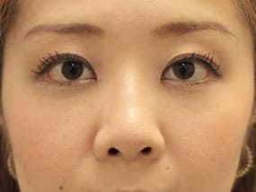 目の下のクマ・タルミ症例手術３ヶ月後（メイクあり）