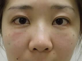 目の下のクマ・タルミ症例手術直後（メイクなし）