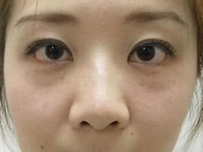 目の下のクマ・タルミ症例手術前