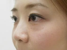 目の下のクマ・タルミ症例手術前