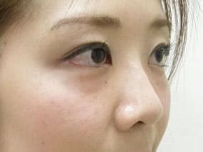 目の下のクマ・タルミ症例手術前