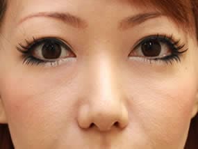 目の下のクマ・タルミ症例：眼窩脂肪注入のデザイン（メイクなし）