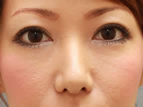 目の下のクマ・タルミ症例：眼窩脂肪注入直後（脱脂リポ法手術直後：メイクなし）