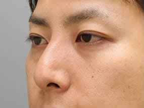 目の下のクマ・タルミ症例手術前