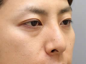 目の下のクマ・タルミ症例手術前