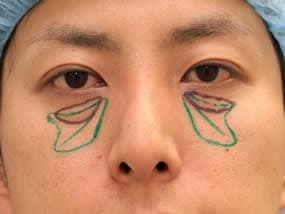 目の下のクマ・タルミ症例手術直後（メイクなし）