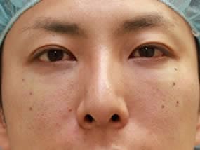 目の下のクマ・タルミ症例手術２週間後（メイクあり）