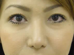 目の下のクマ・タルミ症例手術前（メイクあり）