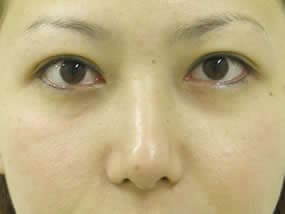 目の下のクマ・タルミ症例手術直後（メイクなし）