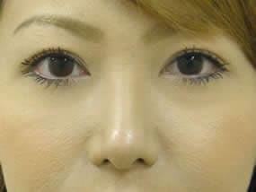目の下のクマ・タルミ症例手術１週間後（メイクあり）