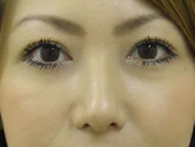 目の下のクマ・タルミ症例手術２週間後（メイクあり）