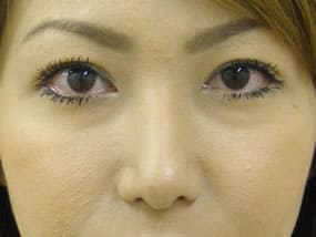 目の下のクマ・タルミ症例手術前